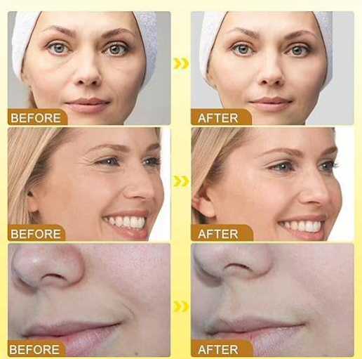 Botox Bee Venom Cream